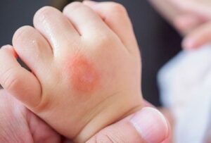 Baby's Eczema